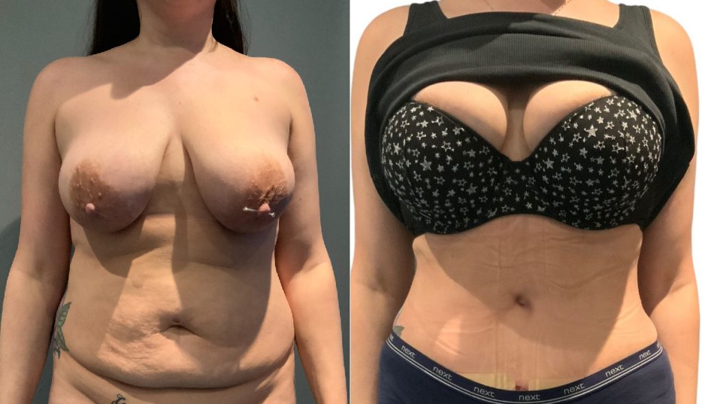 abdominoplasty + lipo