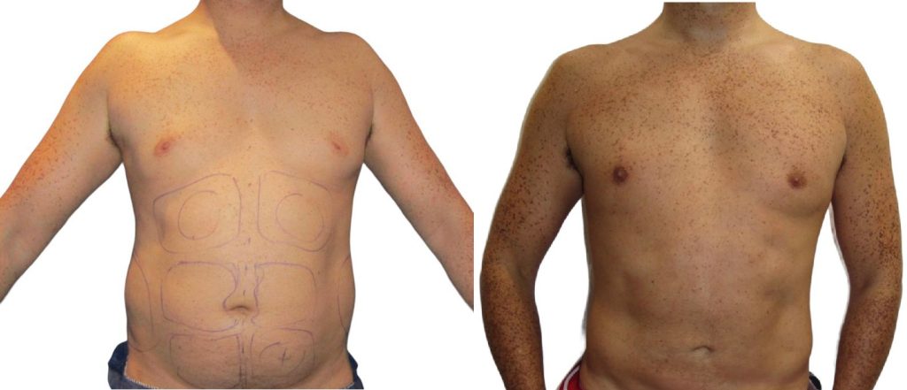 male liposuction