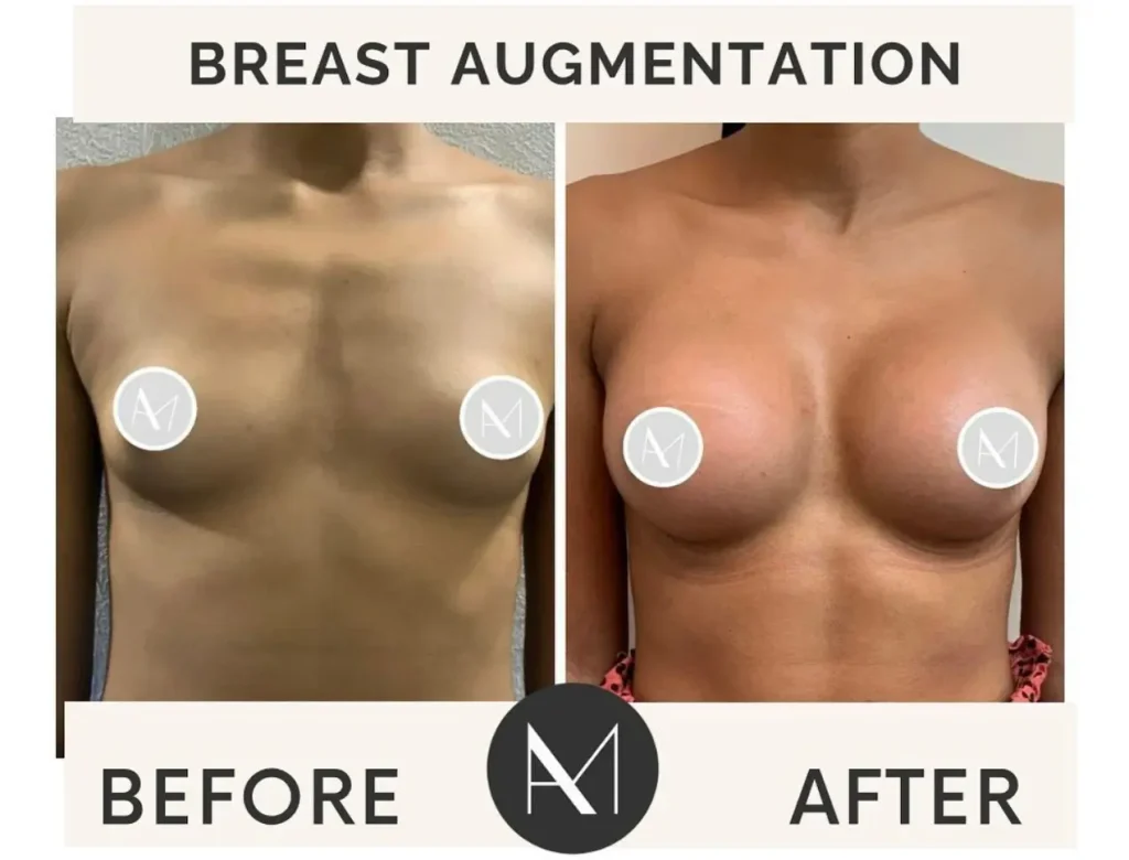 brest augmentation slider