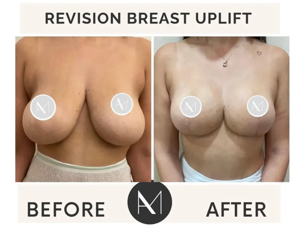 brst uplift 1 slider